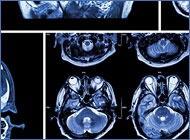 Catastophic Injuries
